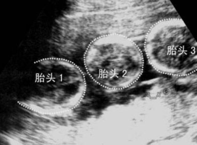 三代试管婴儿费用多少？有哪些优势？